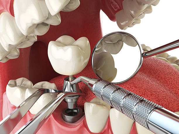 Best Emergency Wisdom Tooth Extraction in Ilco, WA